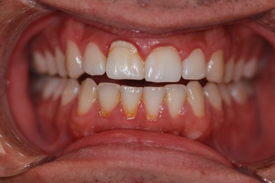 Dental before & after photo