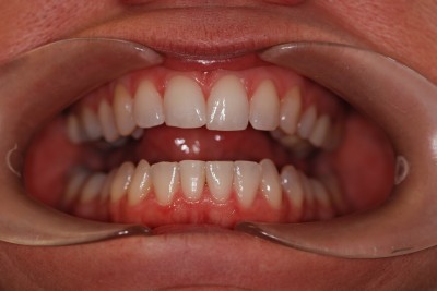 Dental before & after photo